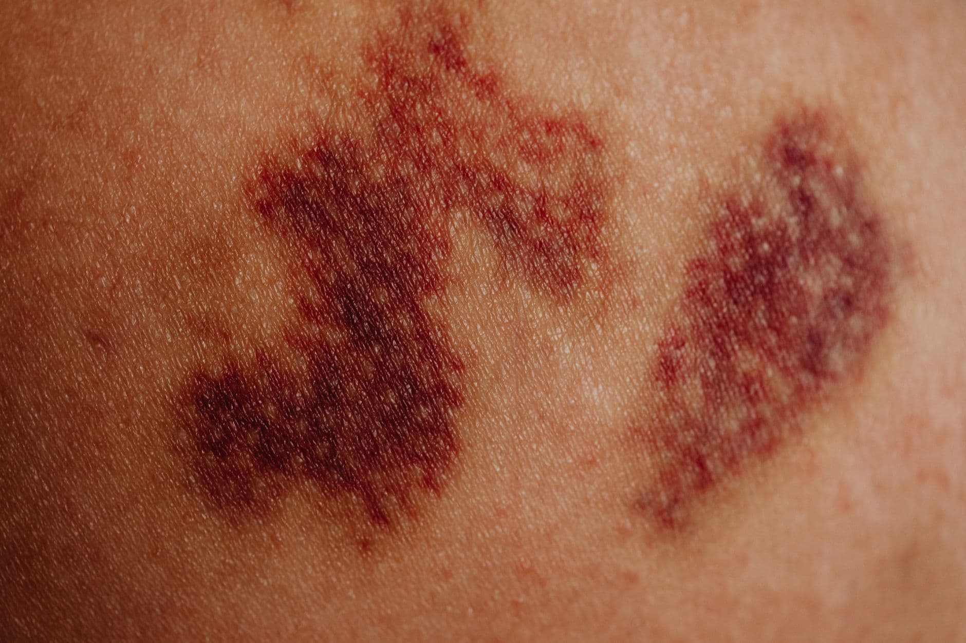 Turns Out Shingles Vaccines Might Save Your Brain Too